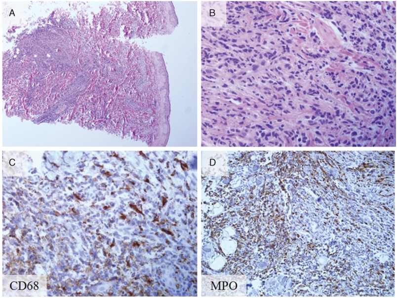 Histopathology and immunohistochemical staining of biopsy from the skin leukemia cutis