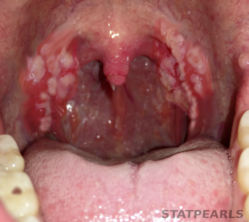 <p>Tonsillitis
