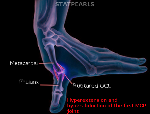 Rupture of the UCL of thumb