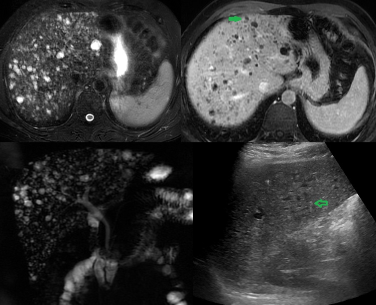 <p>Multiple Biliary Hamartoma, Ultrasound