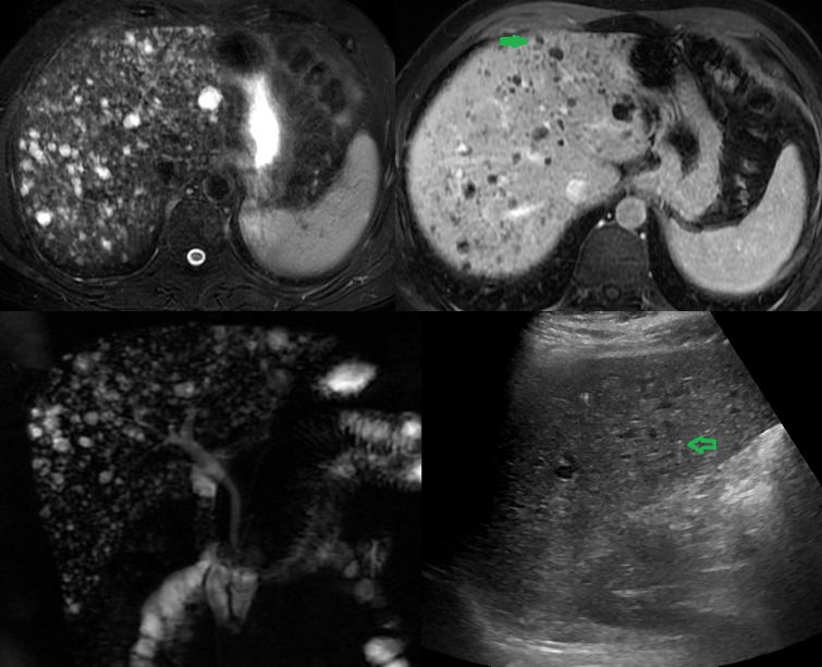 <p>Multiple Biliary Hamartoma