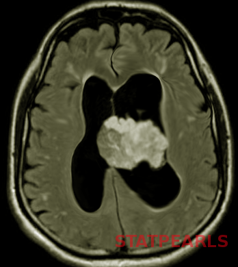<p>Choroid Plexus Papilloma