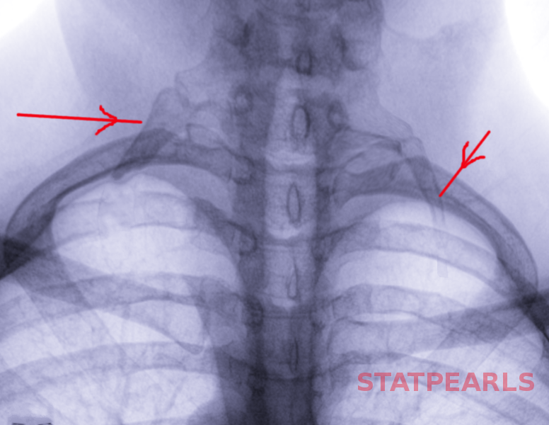 <p>Radiographic Appearance of Bilateral Cervical Ribs